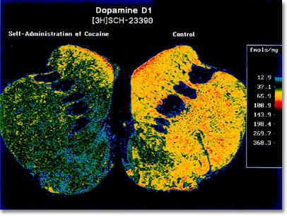 The image shows a brain region affected by cocaine. The right side is normal, and the left from an animal that took cocaine for almost a year. The normal side has lots of yellows and red, showing the normal level of a protein called a dopamine receptor. The loss of yellow and red on the left, shows that cocaine reduces the levels of this receptor; this may explain the drug-seeking behavior that results.