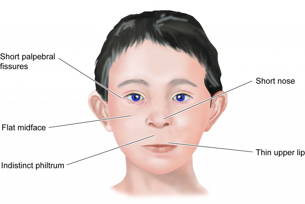 Fetal Alcohol Syndrome Understanding Its Causes Symptoms 55 OFF