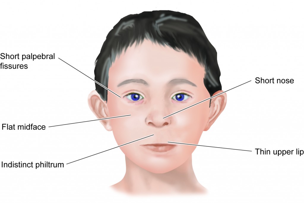 Autism Facial Features In Adults