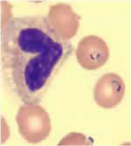 Parasite-infected red blood cells (indicated by purple stain).